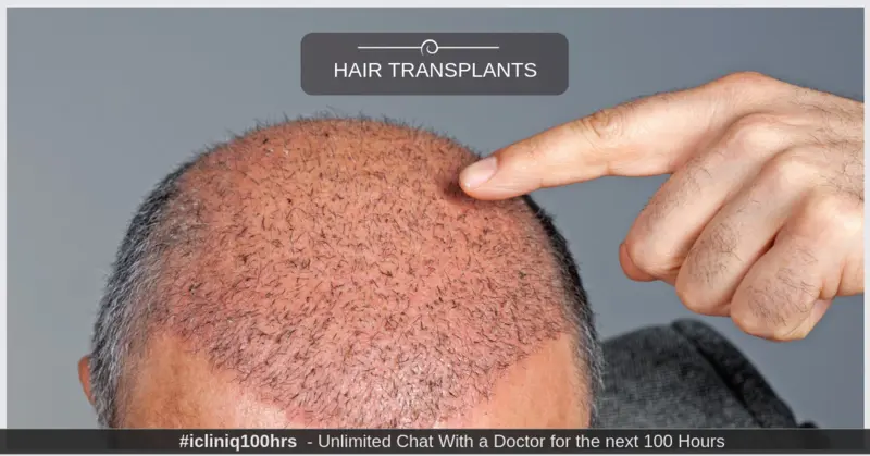 Image:Everything You Need to Know About Hair Transplants Image: Everything You Need to Know About Hair Transplants