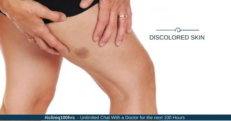 discolored penis pictures Discolored penis pictures
